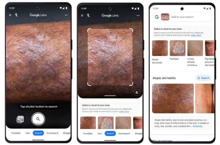 Google Lens : la technologie de reconnaissance d’images vous permet désormais d’en savoir plus sur une éventuelle maladie de peau (grain de beauté, éruption cutanée, etc.)