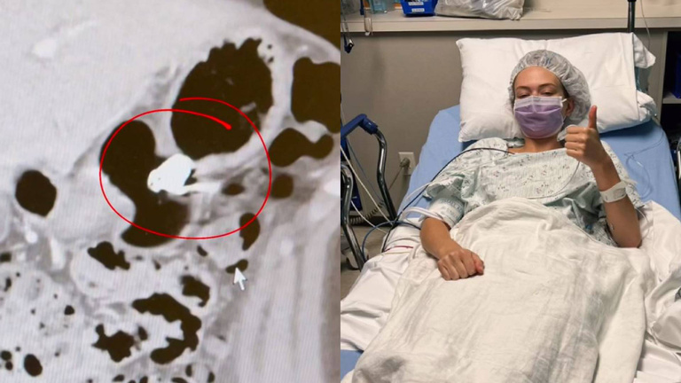 Elle avale un AirPod et met son ventre sur écoute. Il résiste pendant 9 heures